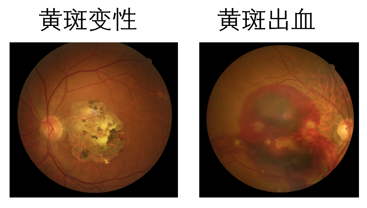 玩手机黄斑病_玩手机黄斑病变_手机玩游戏有黄斑