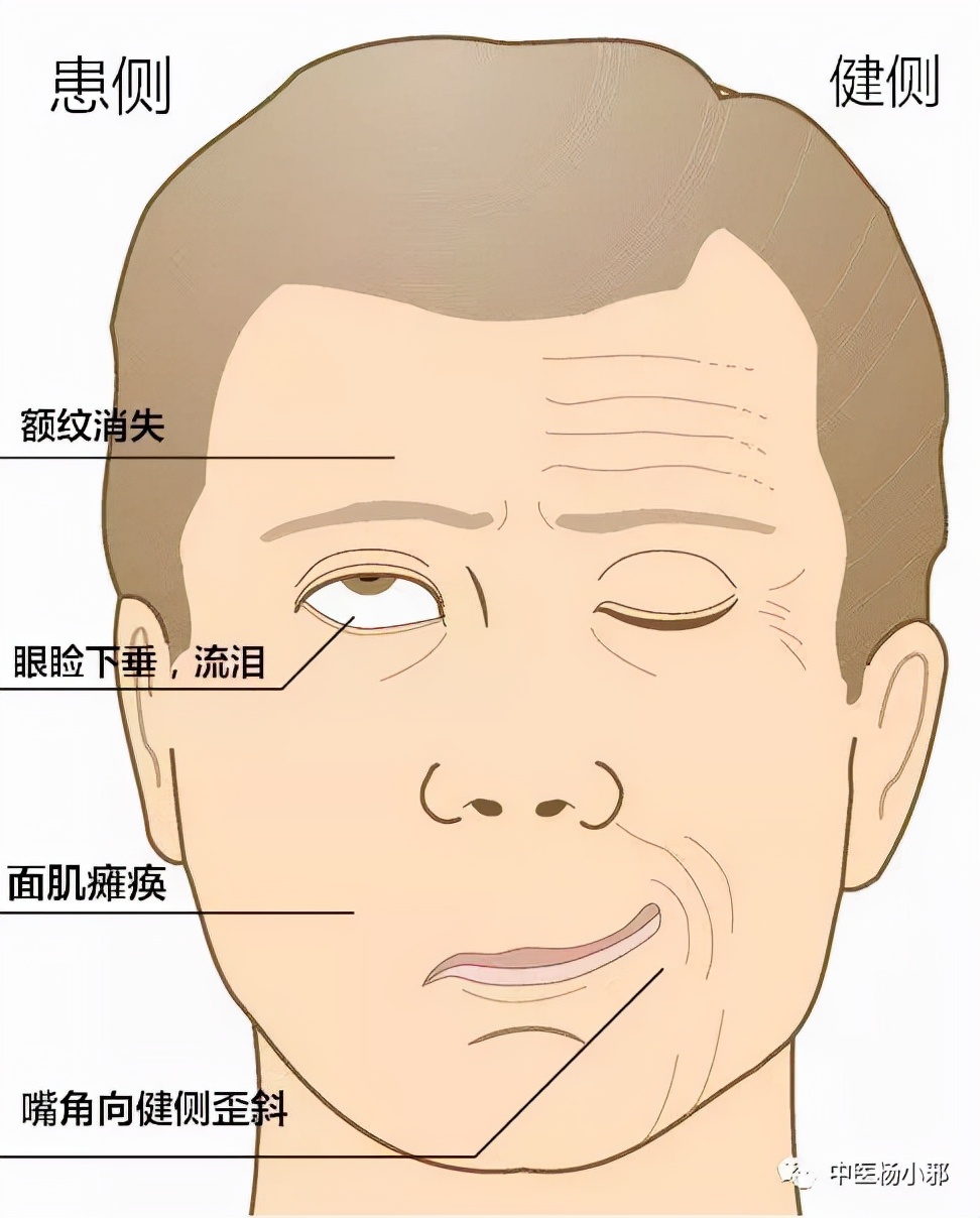 专治面瘫的手机游戏_面瘫神器_治疗面瘫有没有什么特殊好玩